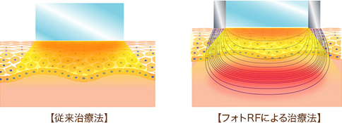 フォトRFによる治療法