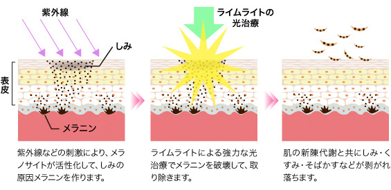 シミ取り 仕組み